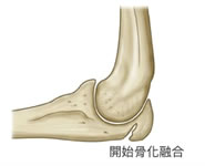 開始骨化融合