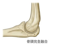 骨頭完全融合