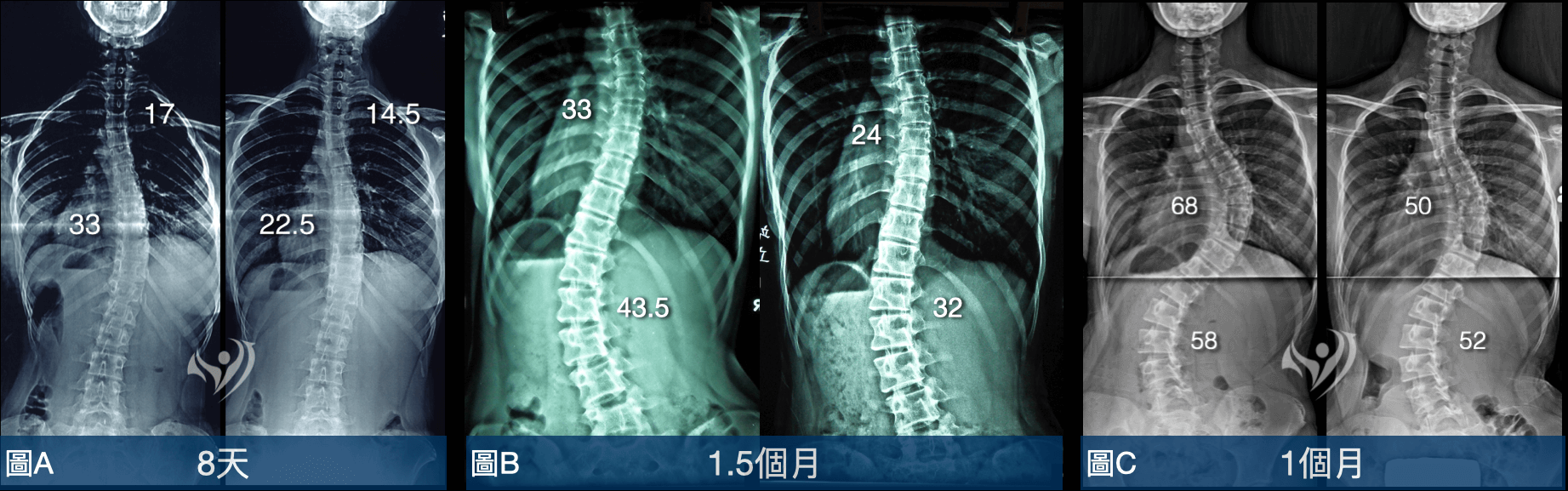 大腦學習訓練法-透過修正動作程式矯正脊椎側彎