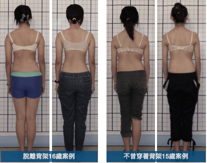 不利用背架改善側彎度數案例