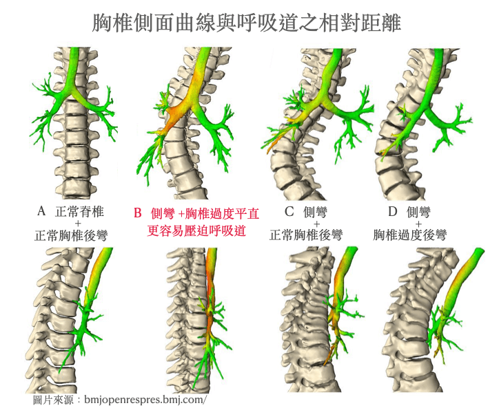 胸椎平直、或向前凹陷減少胸椎與氣管及支氣管之間的距離，且壓迫呼吸道