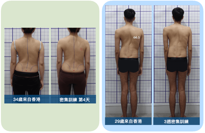 大腦學習訓練側彎矯正法密集訓練改善姿勢外觀