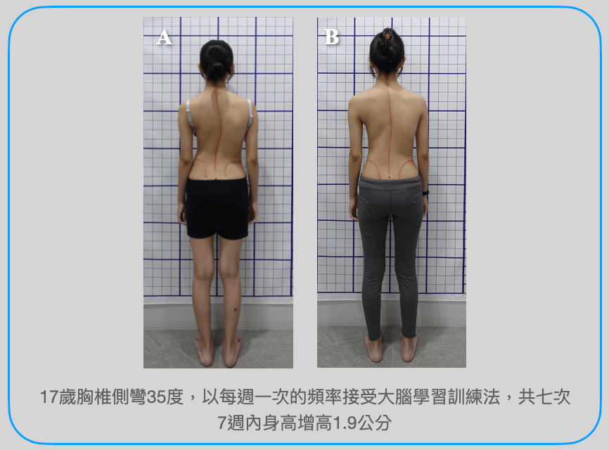 修正體內異常的力量，即何看到姿勢外觀或側彎度數獲得改善