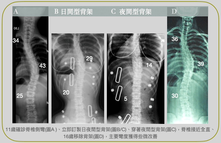 脊椎側彎背架的矯正效果，大部份來自於犧牲次要彎度的結果