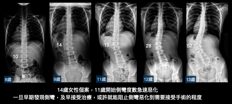 發現側彎時，未經過適當的治療，在青春期的成長加速階段(女性11歲~13歲)，側彎迅速惡化