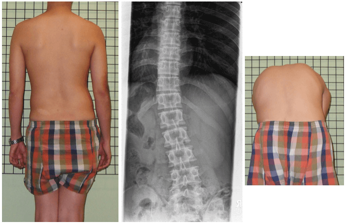 功能性脊椎側彎-不伴隨椎體旋轉