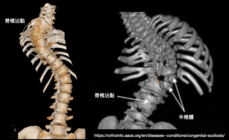 先天性脊椎側彎