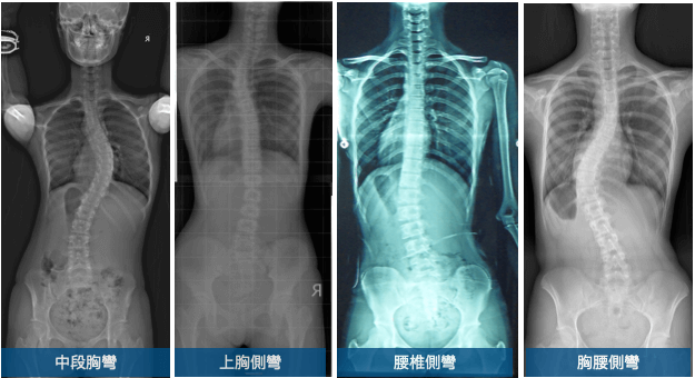 脊椎側彎曲線類型