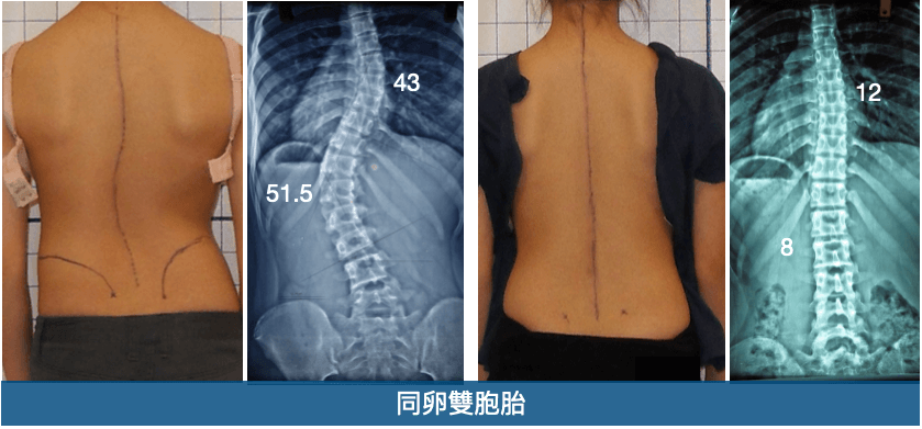 脊椎側彎原因之一：基因