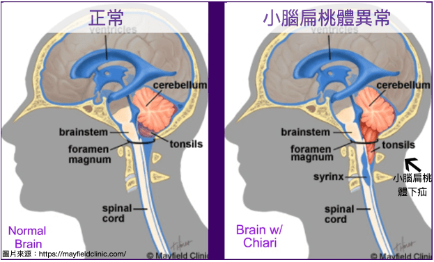 脊椎側彎原因之一：中樞神經系統-腦部功能異常