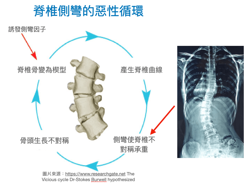 脊椎側彎原因之一：椎體不對稱承重及脊椎生長理論
