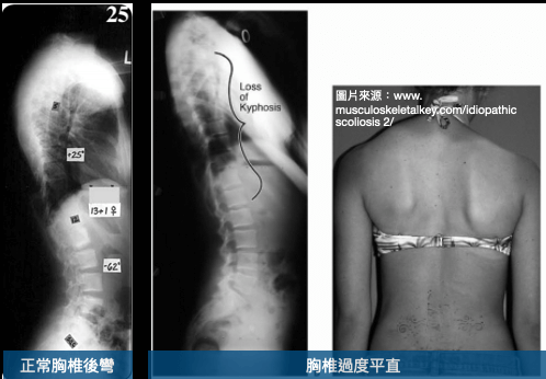 脊椎側彎原因之一：前側脊椎過度生長