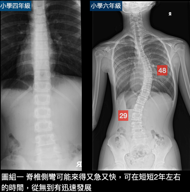 脊椎側彎初期症狀需即時處理，2年內脊椎側彎惡化超過40度