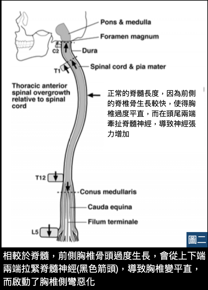 脊椎側彎徵兆-側面姿勢及脊椎側面曲線異常因而啟動胸椎側彎惡化