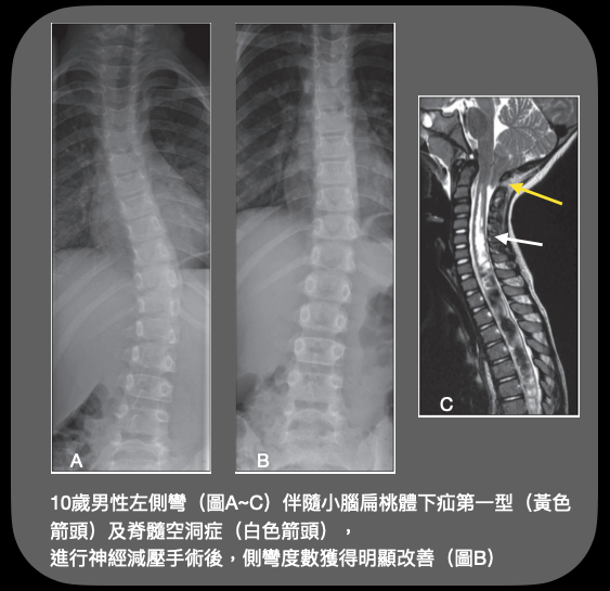 脊椎側彎中樞神經軸異常核磁共振檢查