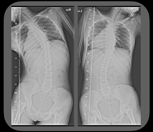 脊椎側彎X光片柔軟度檢查