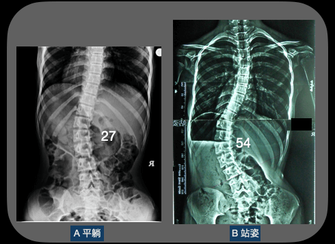 脊椎側彎平躺與站姿X光片度數差異