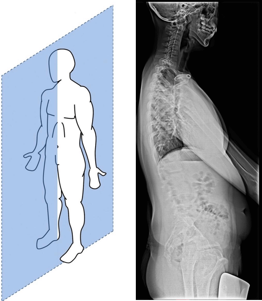 矢狀面, 側面姿勢, 脊椎側面X光片 