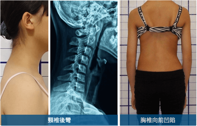 脊椎側彎伴隨頸椎過度平直及胸椎向前凹陷