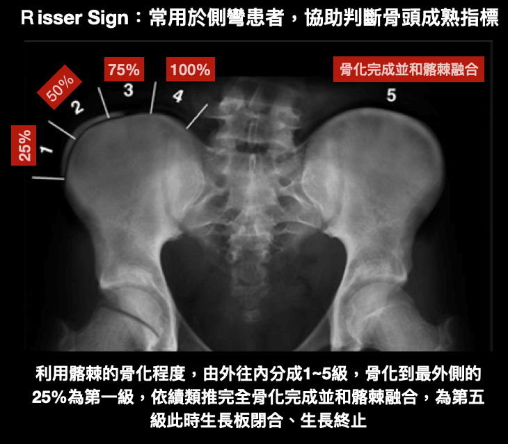 Risser sign用來判定側彎孩子骨頭成熟指標