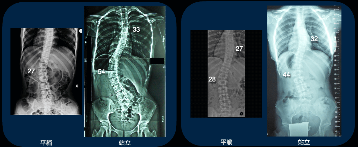 躺姿及站姿下側彎度數之差異