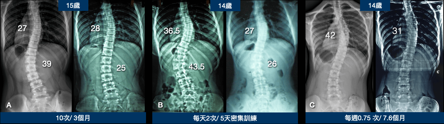 不穿背架矯正脊椎側彎案例