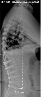 脊椎側面姿勢平衡判斷標準