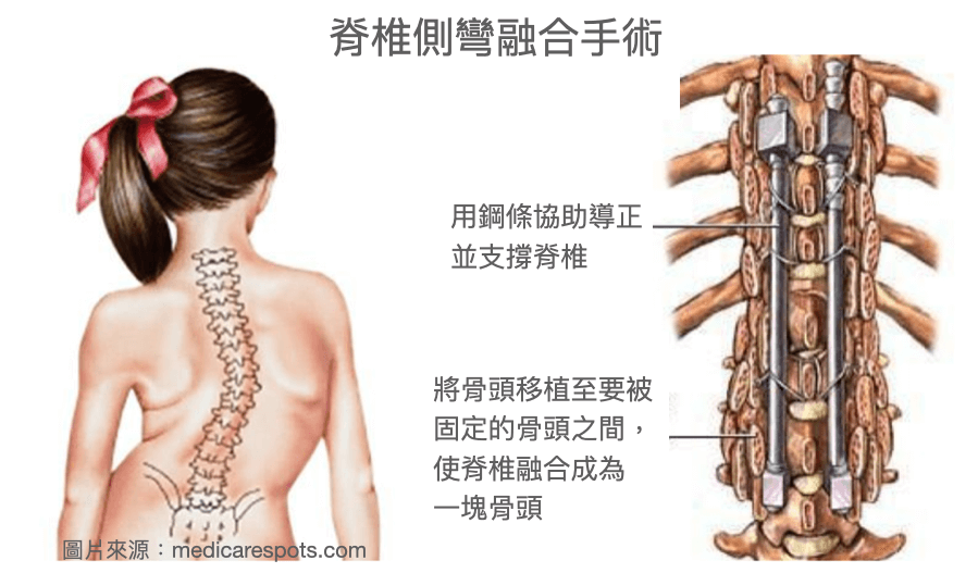 脊椎側彎融合手術，利用鋼條及骨頭移植將脊椎固定