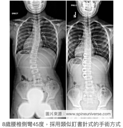 脊椎側彎非融合手術方式Vertebral Body Stapling(VBS)