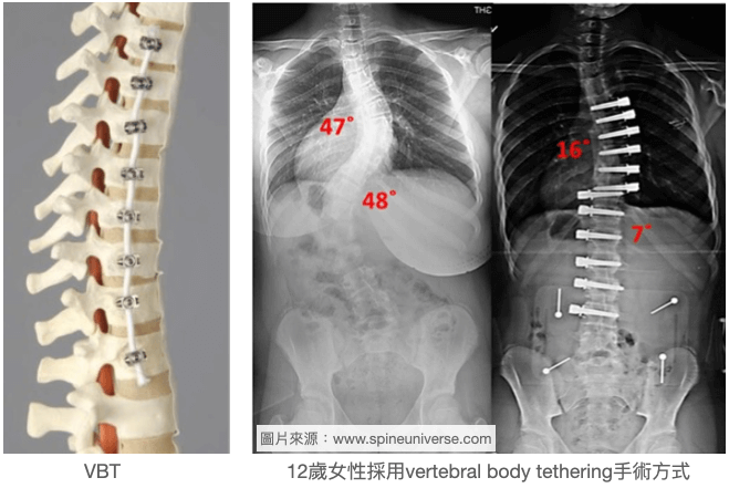 脊椎側彎非融合手術方式Vertebral Body Tethering(VBT)