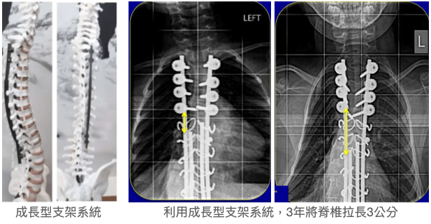 成長型支架系統