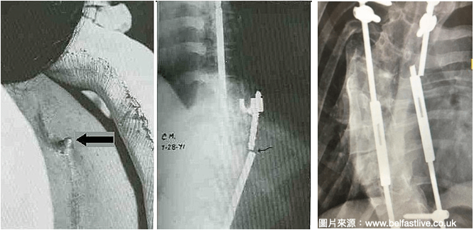 脊椎側彎手術後，金屬支架在人體內斷裂(圖中、圖右)，並穿透皮膚(圖左)