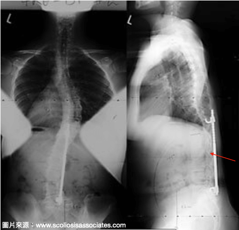 脊椎側彎手術併發症－平背症候群