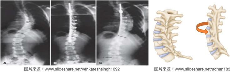 脊椎側彎手術失敗-曲軸現象