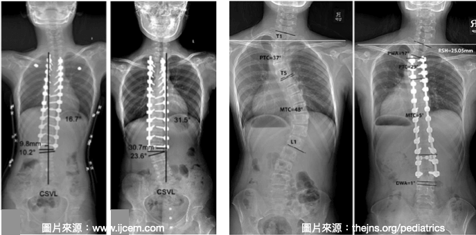 脊椎側彎手術失敗-融合處遠端多出新的側彎彎度