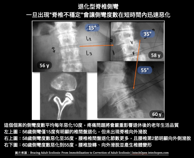 退化型脊椎側彎出現不穩定使側彎急速惡化