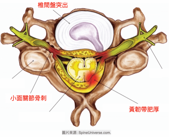 脊椎神經可能受到椎間盤突出、黃韌帶肥厚、或骨刺受到壓迫