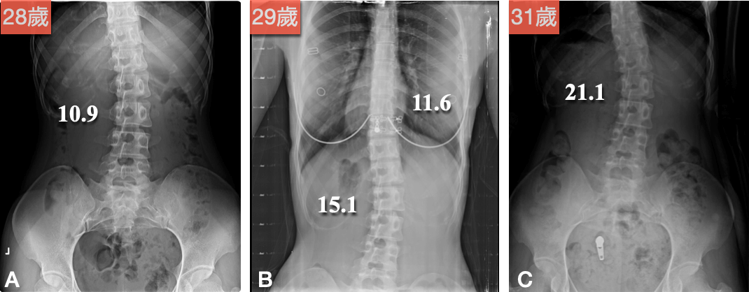 成年人輕度脊椎側彎持續惡化