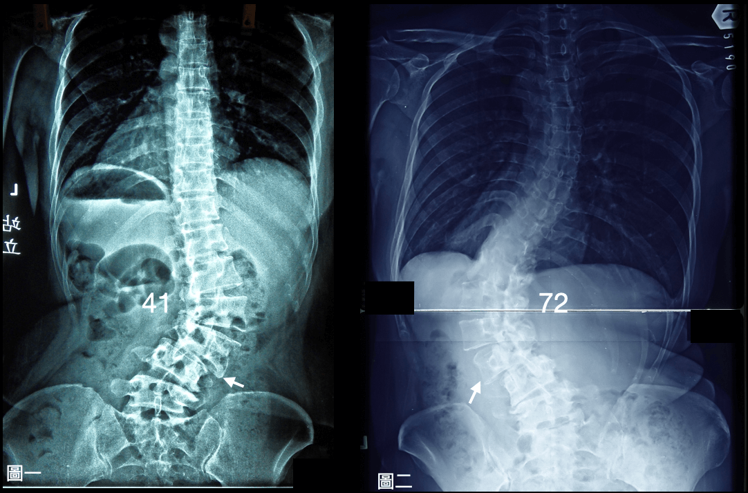 退化型脊椎側彎的疼痛及失能問題，與側彎度數的嚴重度無明顯關聯，與腰椎側面曲線異常有極大的相關性