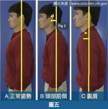 姿勢不良-頭部前傾、圓肩