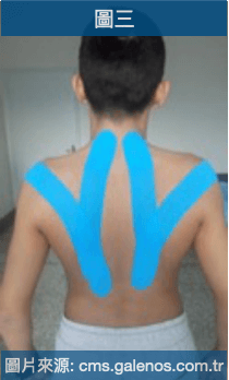 肌內效貼布(kinesio taping)