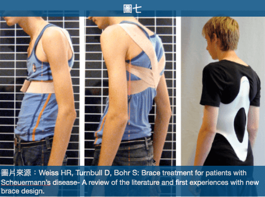駝背矯正帶對僵硬的脊椎沒有幫助