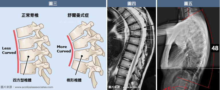 舒爾曼式症(Scheuermann’s  disease)的診斷標斷準： 胸椎後彎(駝背)角度至少大於40度(圖五)、且連續3節椎體呈楔形角度大於5度(圖三、圖四)