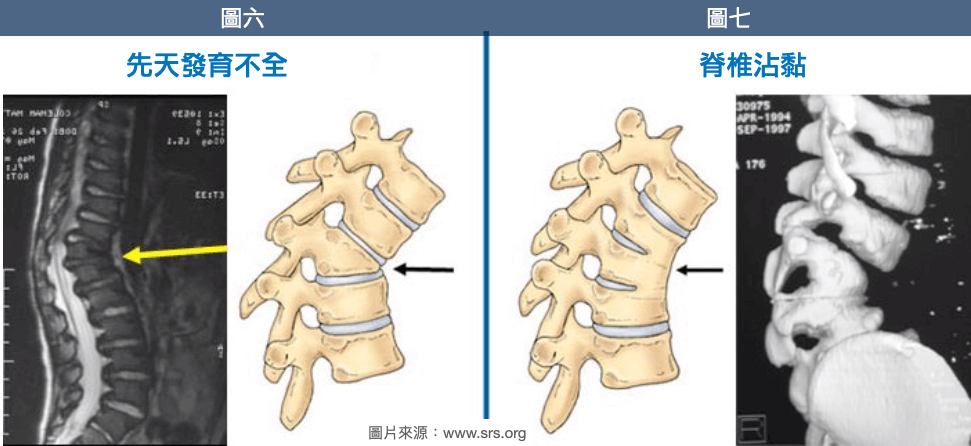 圖六 椎體先天發育不全 圖七 脊椎未分段而沾黏在一起