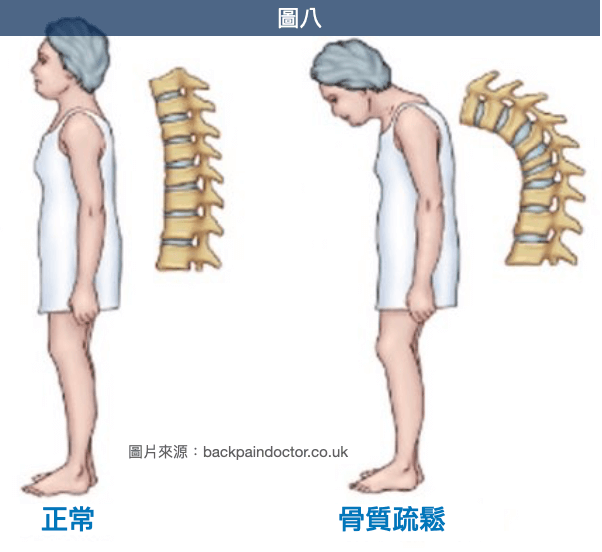 骨質疏鬆容易出現壓迫性骨折導致駝背