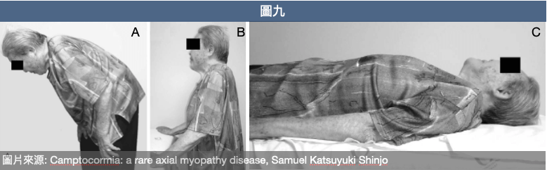 軀幹前彎症(camptocormia)最大特徵是在站姿及行走時出現明顯軀幹前彎(A)，當給予支撐(B)或平躺(C)時，姿勢可獲得明顯改善