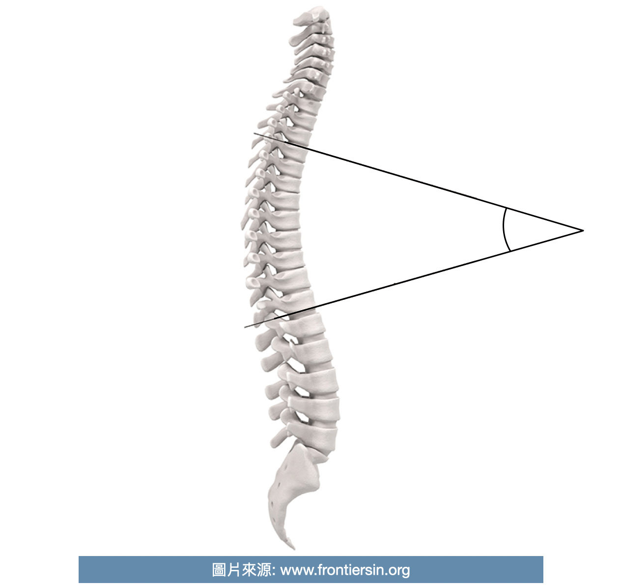 Cobb angle駝背測量方式