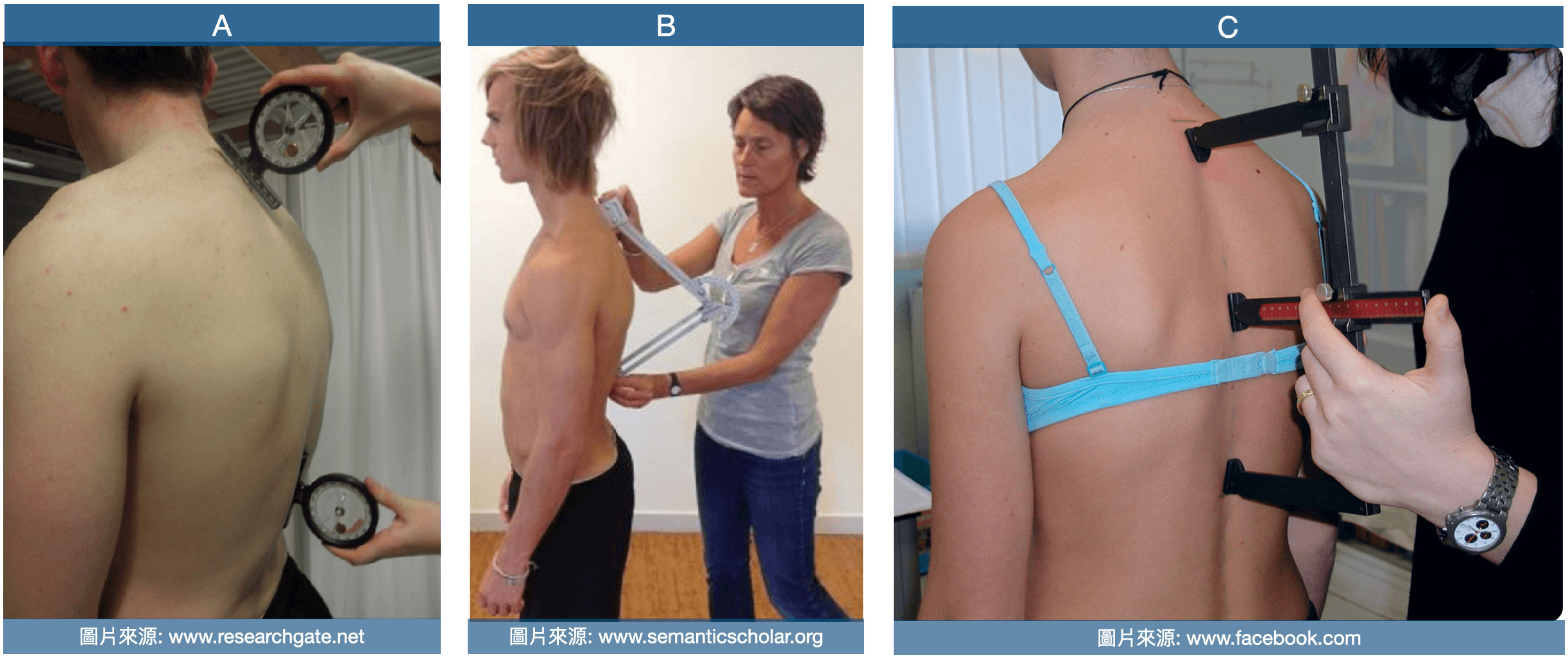 駝背測量器 A. 測斜儀(inclinometer)  B. 德布倫納後彎測量儀(Debrunner kyphometer) C.弧度測量尺(acrometer)