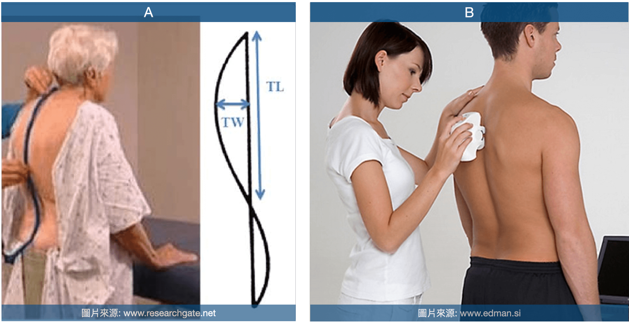 駝背背部輪廓測量方式 A. 柔性曲線尺(flexicurve ruler)   B. 脊椎滑鼠(spinal mouse) 