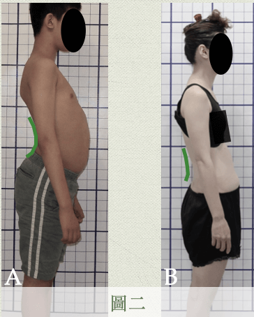 同樣是胸腔後倒，柔軟者的腰椎前彎幅度傾向增加(A)、僵硬者的腰椎前彎則不足(B)